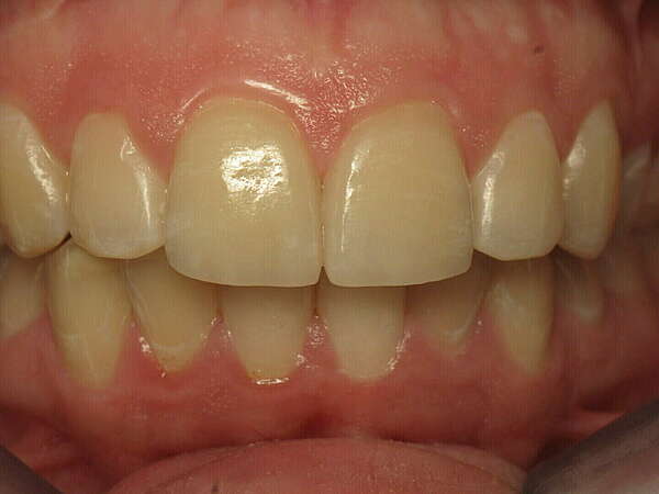 FACETTES ET DENTURE SUR IMPLANTS MARSEILLE 08