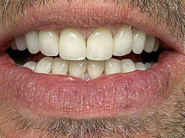 CAS CLINIQUE 4 - FACETTES