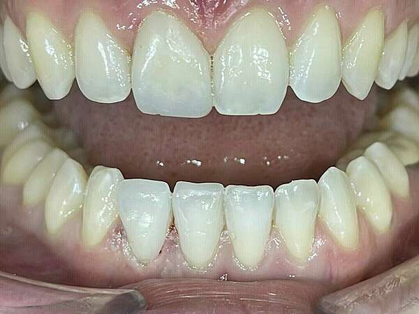 CAS CLINIQUE 5 - FACETTES