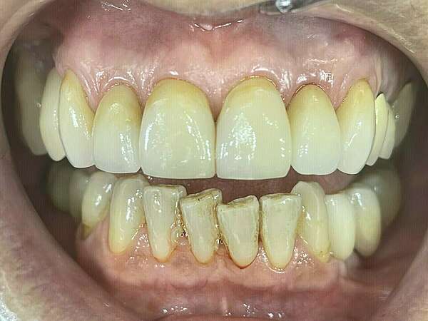 CAS CLINIQUE 2 - FACETTES