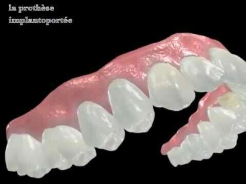 PROTHÈSE IMPLANTO PORTÉ