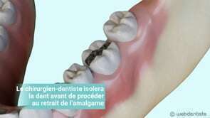 Remplacement d'un amalgame par un inlay