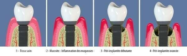 LES PERI-IMPLANTITES