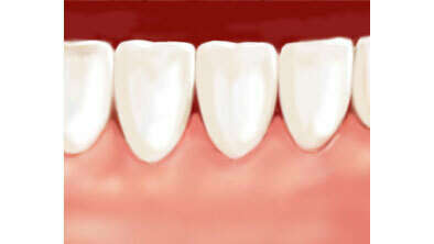 GREFFE ÉPITHÉLIO-CONJONCTIVE