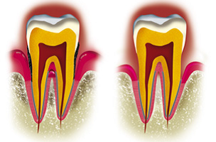 GINGIVITES, PARODONTITES ET LEURS TRAITEMENTS