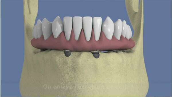 Mandibule complète et traitement implantaire pour un bridge fixe scellé