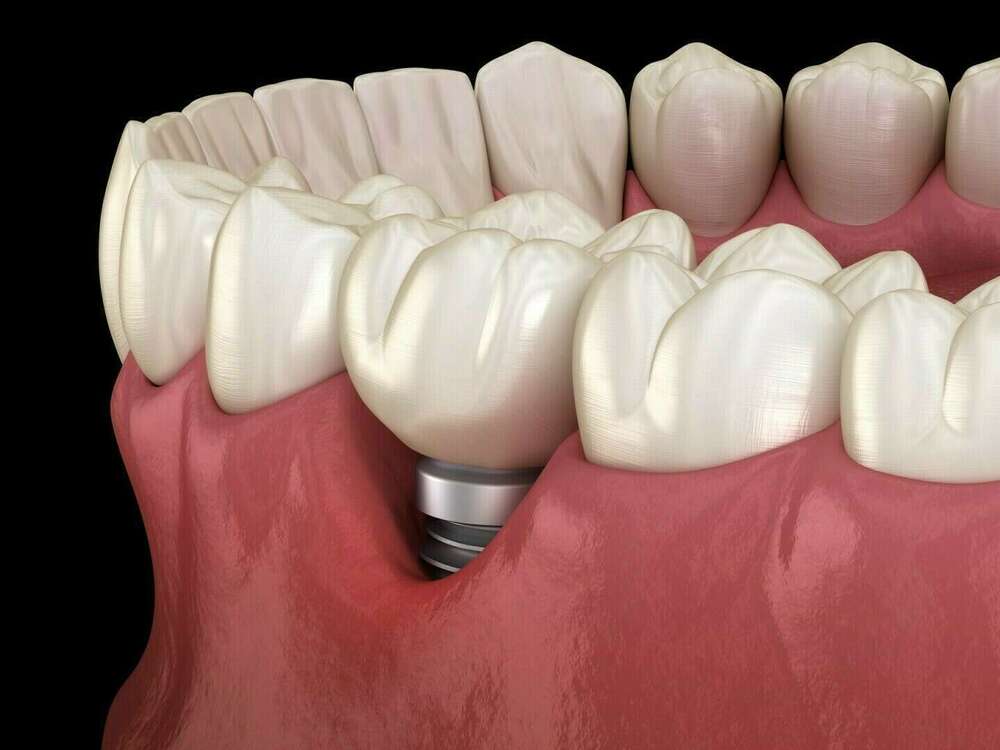 La péri-implantite