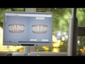 INVISALIGN ET ITERO DENTAL SCAN