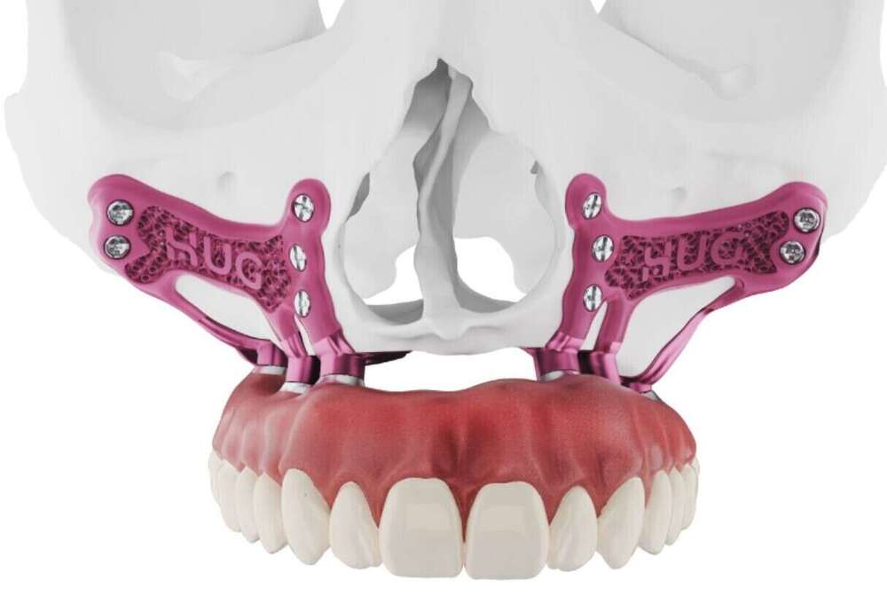 Implants dentaires sub-périostés