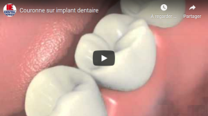 Couronne sur implant dentaire