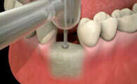 Pose d'implants dentaires