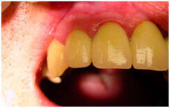 CAS CLINIQUE N° 1: REMPLACEMENT SUR IMPLANT D'UNE DENT ANTÉRIEURE SUPÉRIEURE L'INCISIVE LATÉRALE