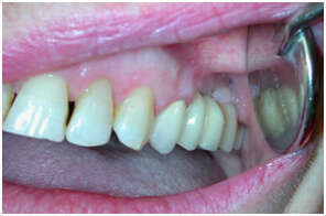 CAS CLINIQUE N° 2 : RÉTABLISSEMENT DE LA MASTICATION SUR IMPLANTS