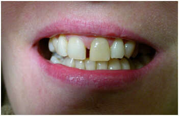 CAS CLINIQUE N° 3 : LE BLANCHIMENT DES DENTS