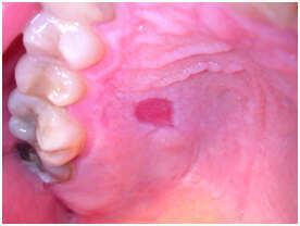 CAS CLINIQUE N° 4 : L’INFECTION DES RACINES