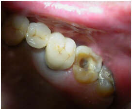 CAS CLINIQUE N° 5 : LA FRACTURE D’UNE DENT ET SON REMPLACEMENT