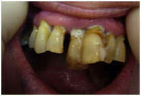 CAS CLINIQUE N° 6 : LA RÉHABILITATION D’UN SOURIRE PAR PROTHÈSE FIXE