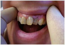 CAS CLINIQUE N° 7 : LA RÉHABILITATION D’UN SOURIRE PAR PROTHÈSE FIXE SUR UNE JEUNE PATIENTE