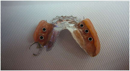 CAS CLINIQUE N° 13 : UNE PROTHÈSE AMOVIBLE MÉTALLIQUE STABILISÉE PAR DES MINI-IMPLANTS