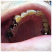 CAS CLINIQUE N° 14 : REMPLACEMENT PAR IMPLANTS DE PRÉMOLAIRES DU HAUT PERDUES SUITE À UN CHOC