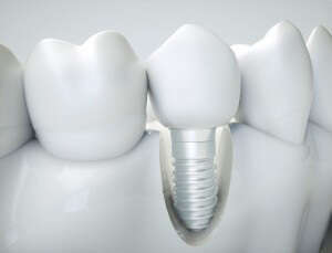 IMPLANT DENTAIRE ZIRCONE