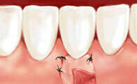 Greffe gingivale à visée esthétique