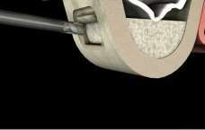 La greffe osseuse intra sinusienne ou sinus lift