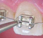 Système de brackets auto-ligaturants