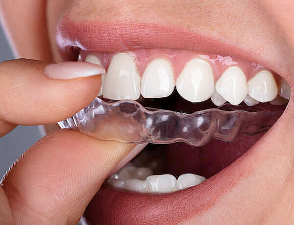 L'Orthodontie invisible