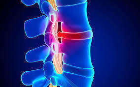 Hernie discale : les manipulations vertébrales sont-elles dangereuses ?