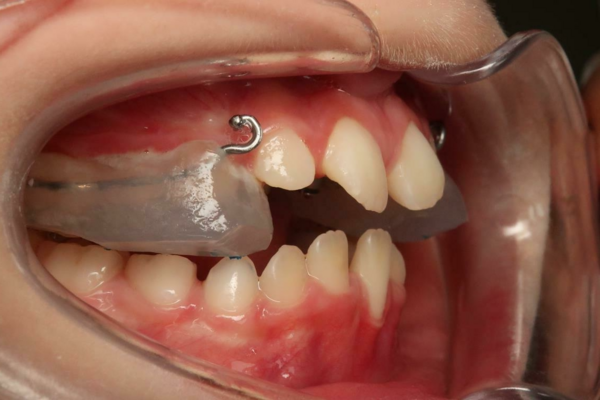 LE MASQUE FACIAL ET LA GOUTTIÈRE