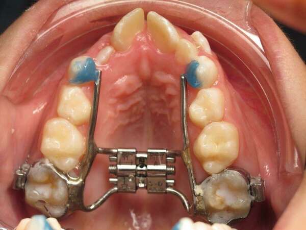 Le disjoncteur sur bagues