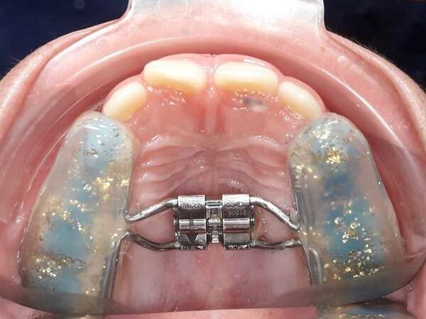 LE DISJONCTEUR SUR GOUTTIÈRES