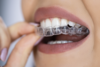 gouttieres orthodontiques