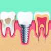 Implant dentaire et sa couronne entre deux dents naturelles, schéma en coupe