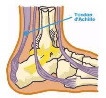 La tendinite d’Achille