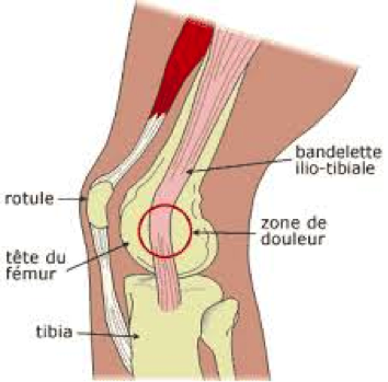 Le syndrome de l’essui glace