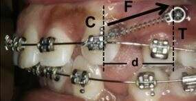 CYCLIC LOADING (VIBRATION) ACCELERATES TOOTH MOVEMENT IN ORTHODONTIC PATIENTS