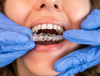 LA TECHNIQUE INVISALIGN® À LYON 4