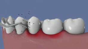 Le laser dans le traitement de la parodontite