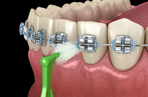 Combiner implantologie et orthodontie : pour une réhabilitation complète du sourire - Dr Frédéric Ouazan