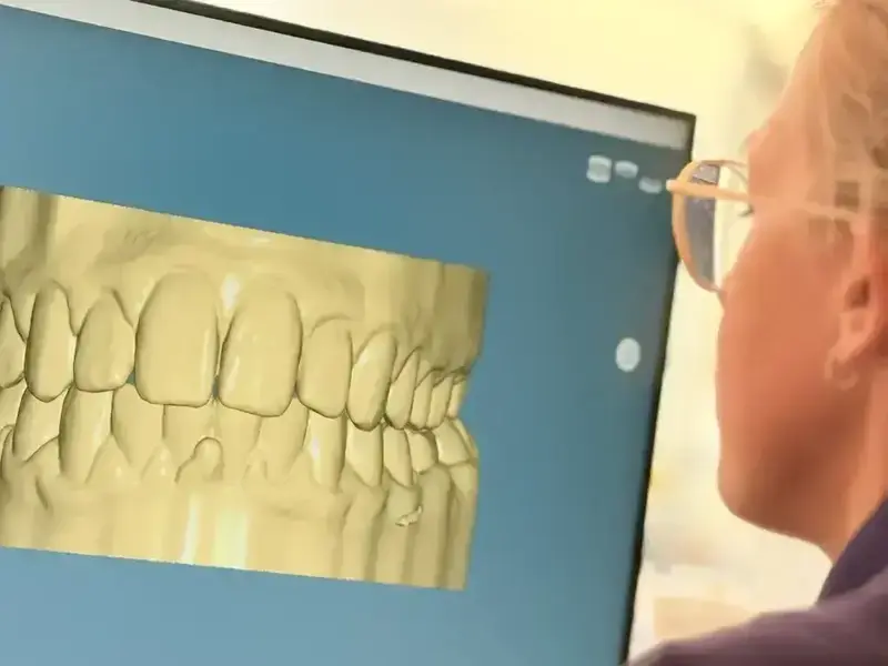 Préparation d'impression de modèle 3D des arcades dentaires dans notre laboratoire interne.