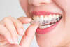 photo d'un aligneur transparent pour traitement d'orthodontie invisible