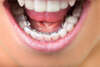 appareil linguale pour orthodontie invisible