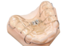 appareil dentaire type plaque à vérin sur un model en résine, appareil d'orthodontie interceptive