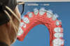 préparation en 3D pour collage indirect de bagues pour un traitement en orthodontie