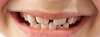 sourire enfant avant première consultation orthodontie