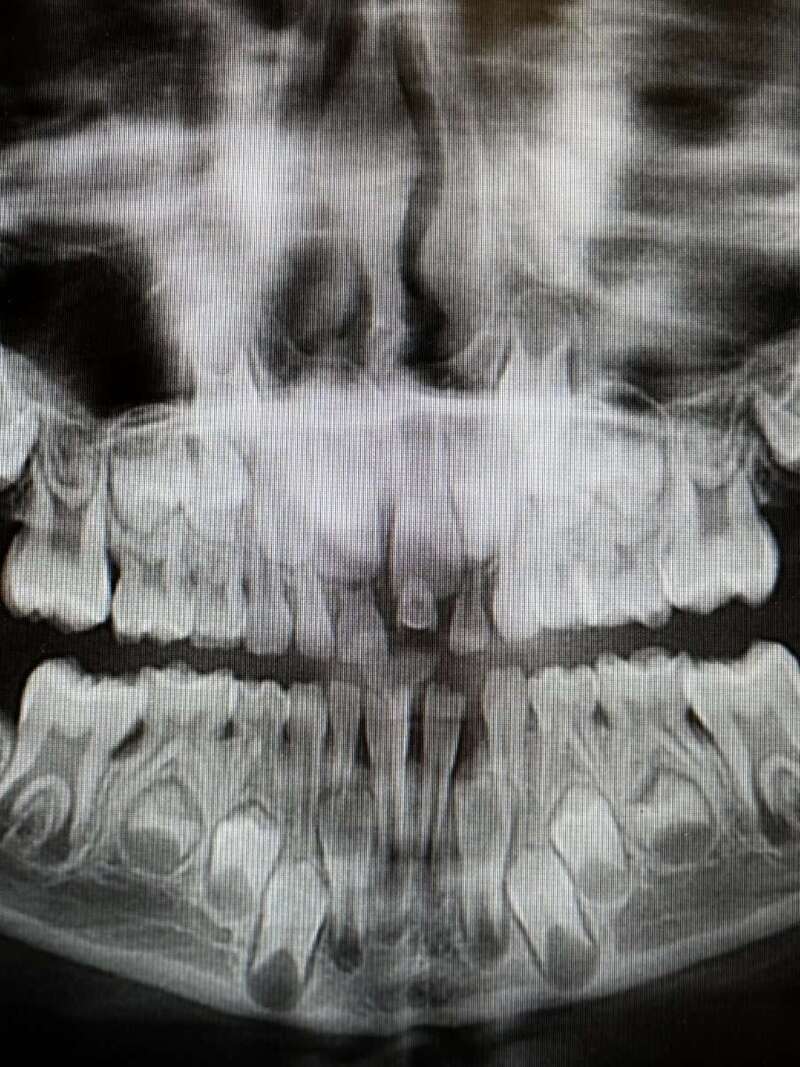 radio panoramique dentition enfant, lors d'un bilan pour orthodontie