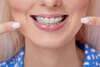 bagues céramique pour traitement d'orthodontie adulte discret