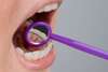 pose d'un fil de contention après traitement d'orthodontie adulte